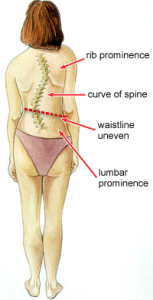 scoliosis, back pain, back ache, spine curve, 